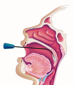 Coastal Ear, Nose & Throat, LLC - Patient Services for Radiofrequency ...