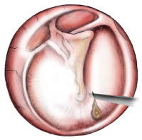 Myringotomy_Ear_Tubes_Savannah_GA_Coastal_ENT