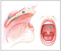Pillar_Procedure_Snoring_Sleep_Apnea_Coastal_ENT_Savannah_GA