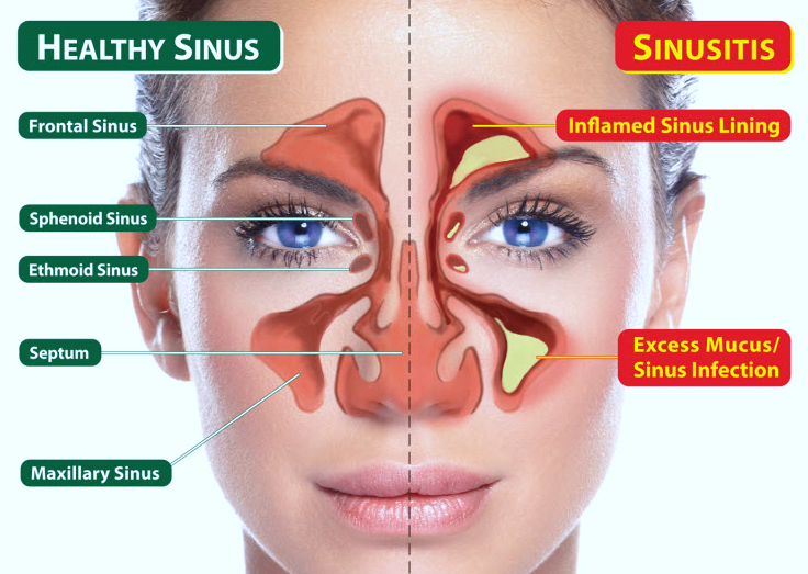 Sinusitis FAQs | ENT Specialty Care